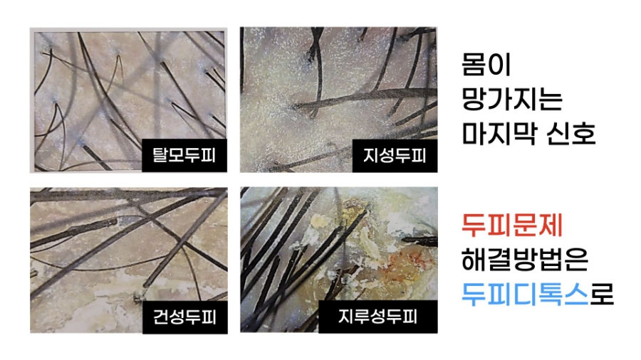 SLON HAIR | 에이지락 두피디톡스 — 두피도 피부, 건강의 신호