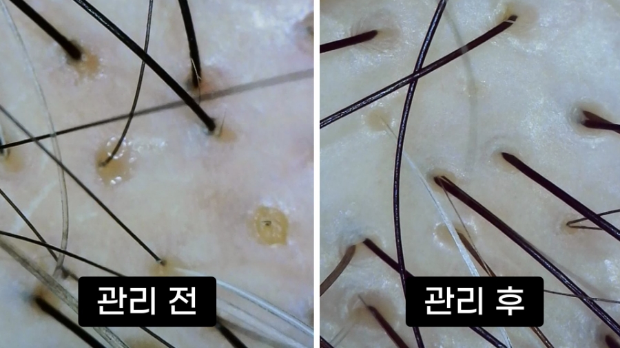 두피 셀룰라이트와 건강 신호