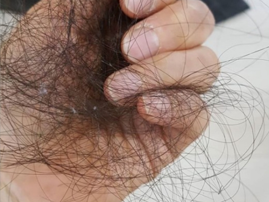 슬론헤어 두피 상태 확인 상담